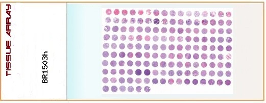 Multiple breast disease with NAT breast tissue array, including fibroadenoma, intraductal carcinoma, invasive carcinoma of no special type, invasive lobular carcinoma, invasive breast carcinoma with medullary characteristics, cystosarcoma phyllodes, pathology grade, TNM and clinical stage (AJCC 8th edition), with IHC results of Her-2\ER\PR - 75 cases/150 cores (core size 1.0mm),